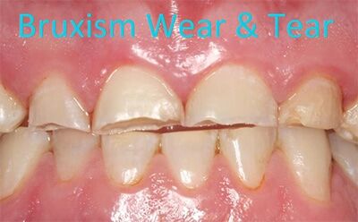 Bruxism - Teeth Grinding - Causes & Symptoms