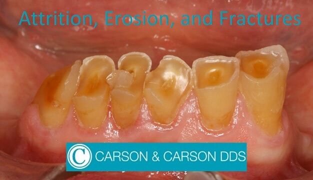 Atrición, erosión y abfractura dental