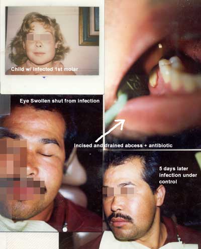 Ojo hinchado por infección dental