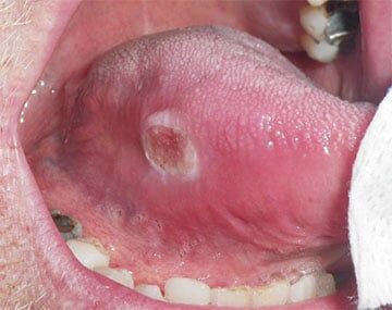 chewing tobacco cancer symptoms Oral Cancer - Symptoms, Diagnosis, Treatment