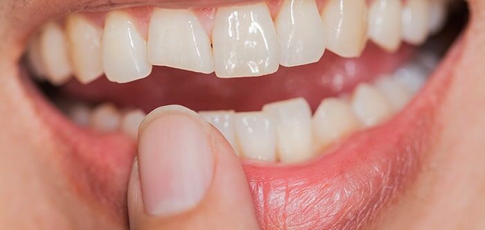Fractured Tooth
