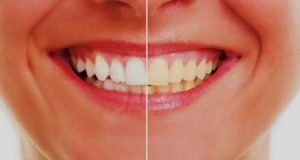 Before/After Teeth Whitening